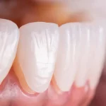 Porcelain Veneers Vs. Lumineers: Which One Is Right For You?