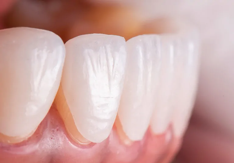 Porcelain Veneers Vs. Lumineers: Which One Is Right For You?